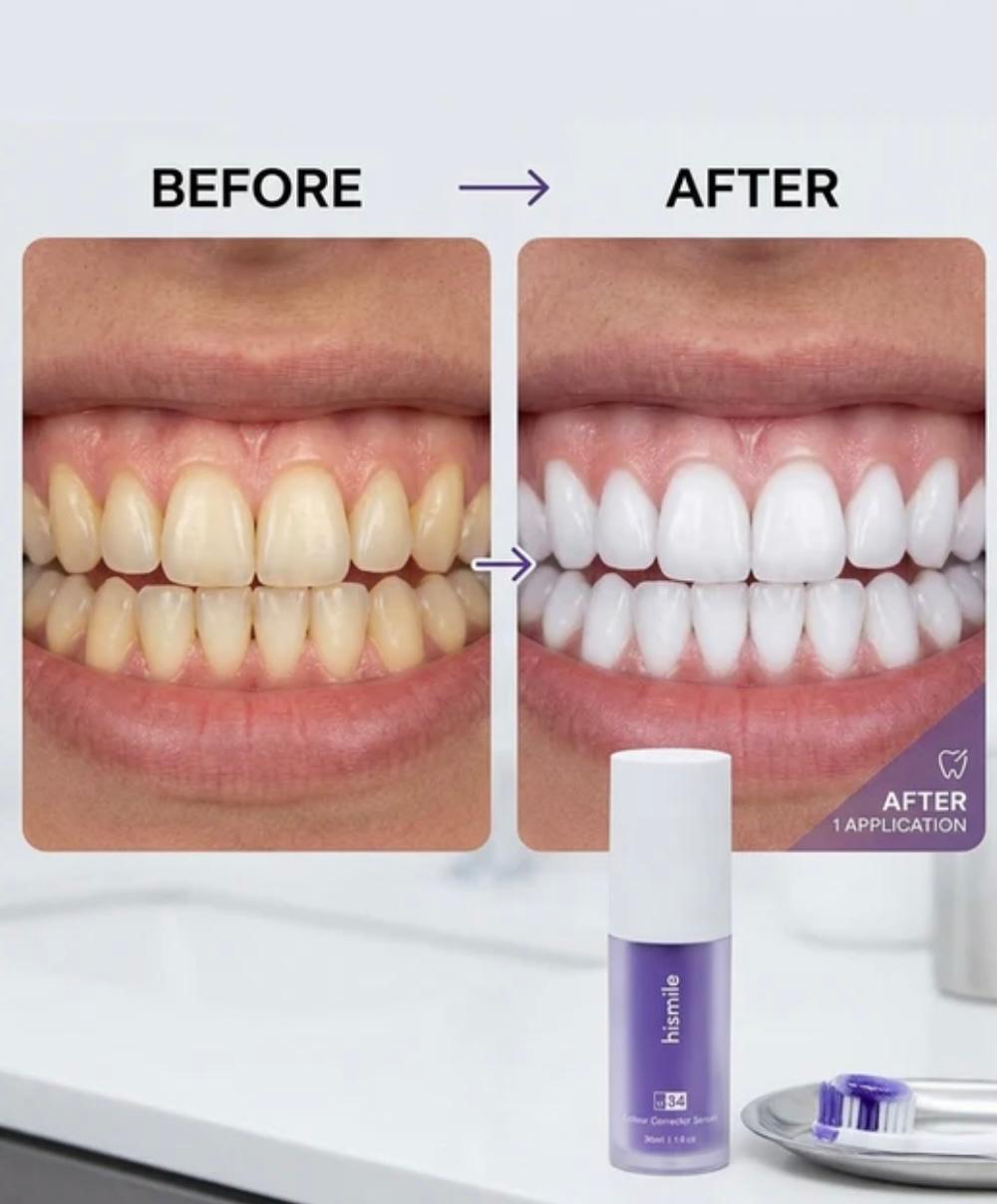 Teeth Whitening