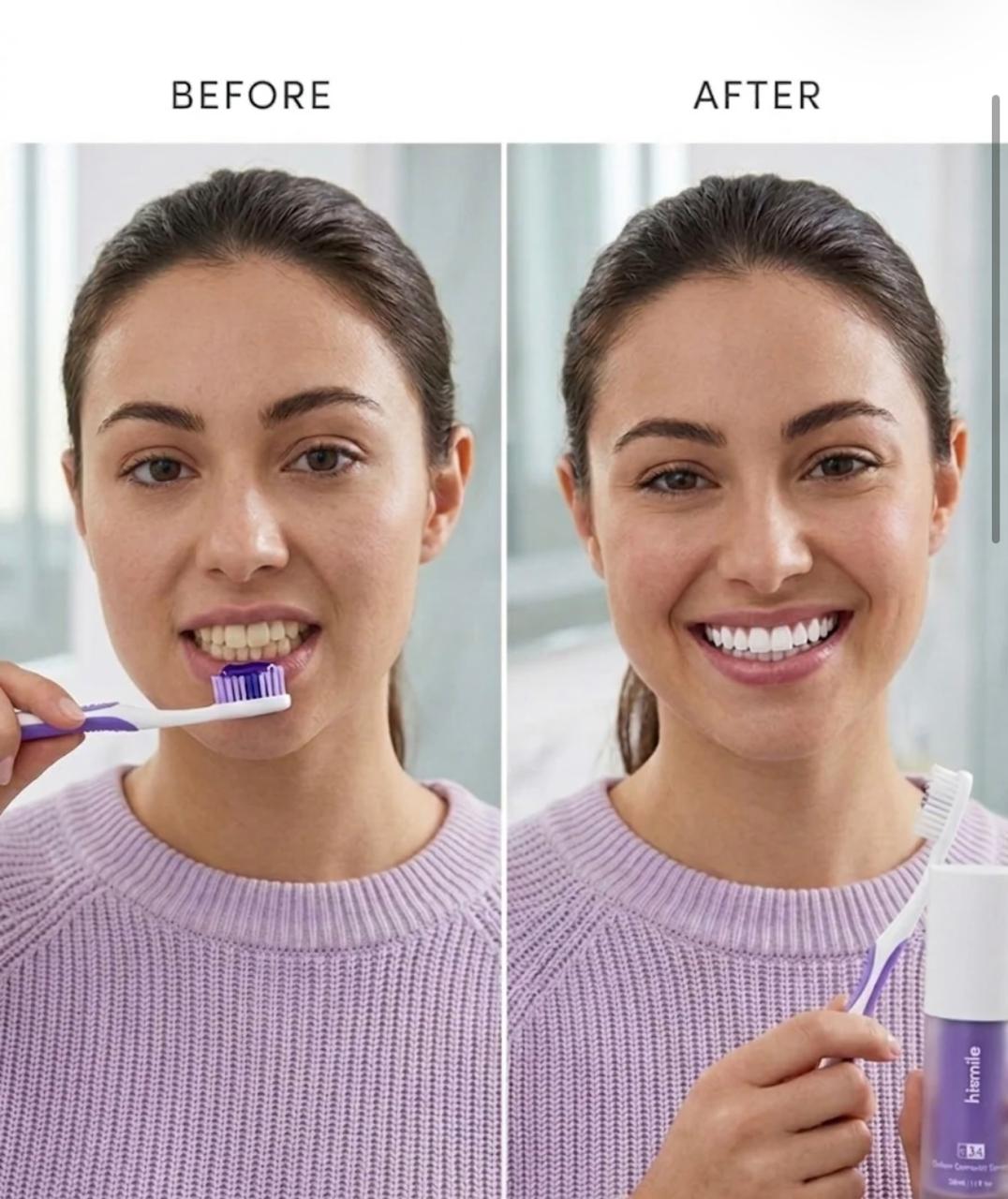 Teeth Whitening